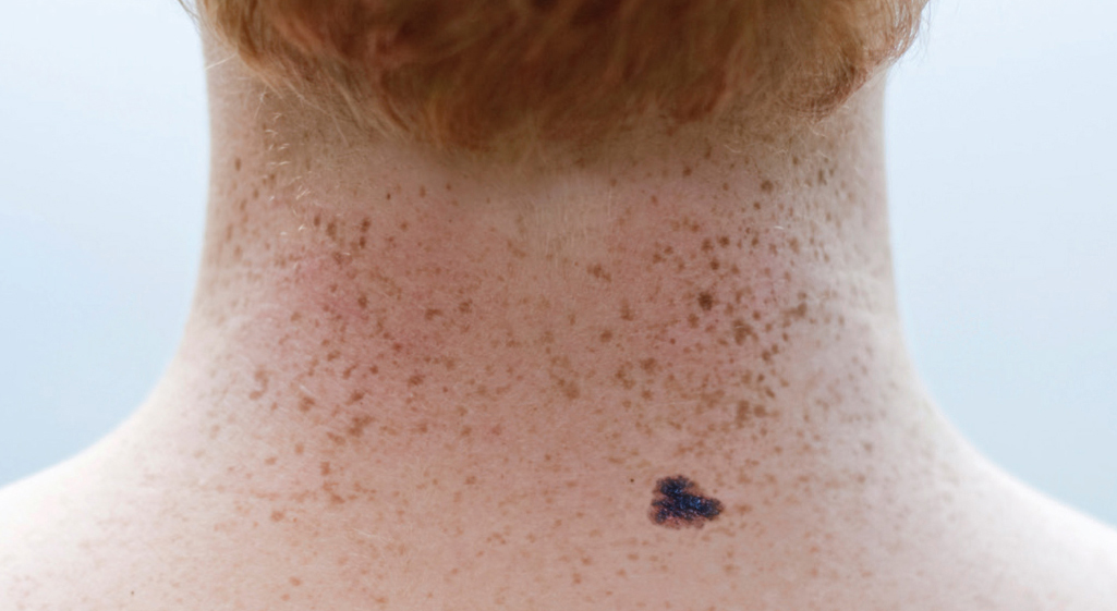 Nærbilde av en persons nakke med mange fregner og en enkelt, mørk, uregelmessig formet føflekk nær basen.