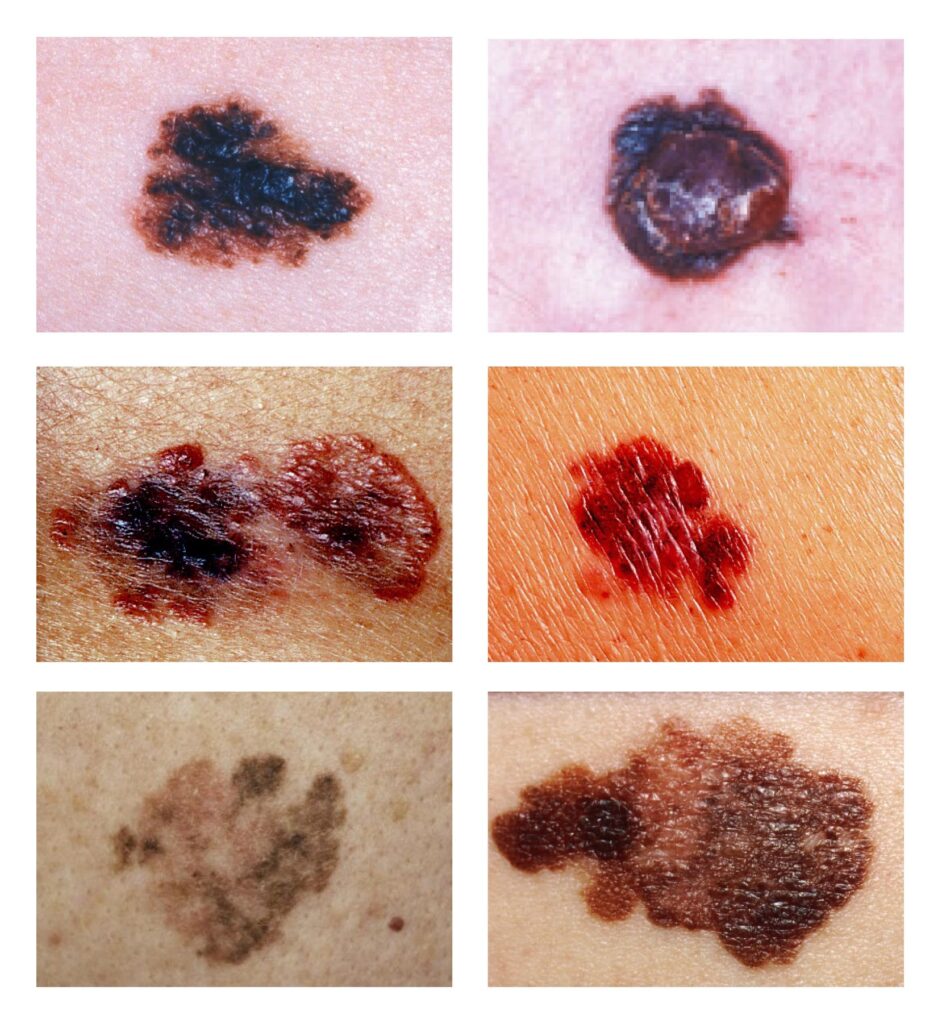 Seks nærbilder av føflekker med varierende former, farger og teksturer, noen ser uregelmessige og mørke ut, på menneskelig hud.